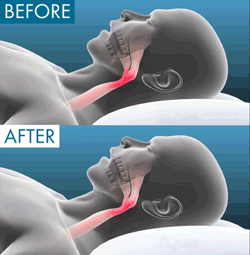 Anti Snore Mouth Piece